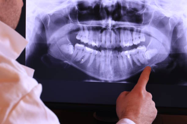 Best Emergency Wisdom Teeth Removal in Saranap, CA