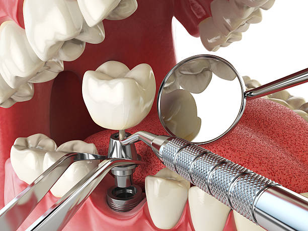 Best Emergency Treatment for Toothache in Saranap, CA
